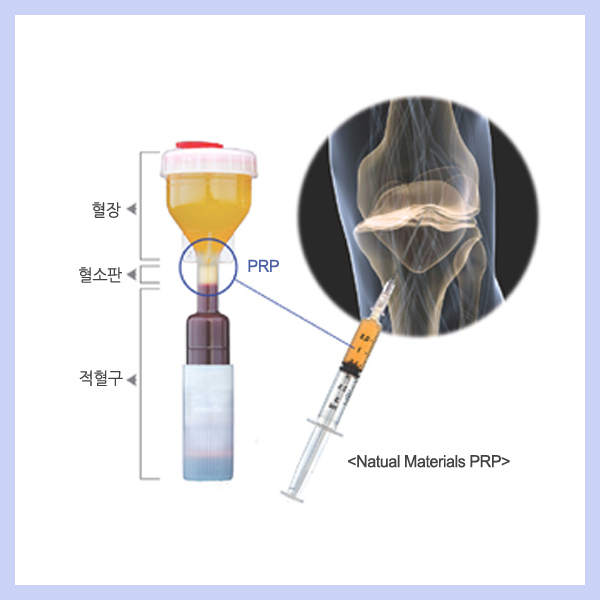 PRP 자가혈주사 안내 이미지